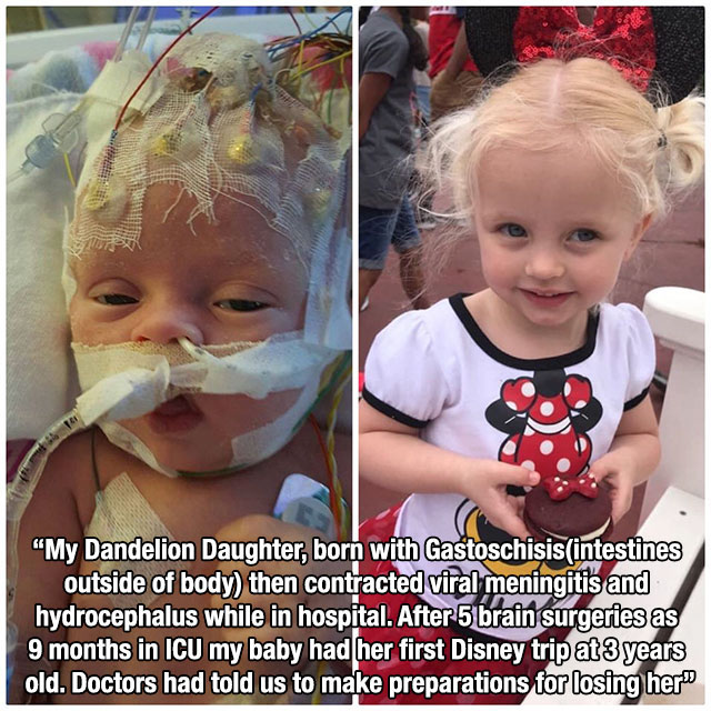 baby born with intestines outside body before - "My Dandelion Daughter, born with Gastoschisisintestines outside of body then contracted viral meningitis and hydrocephalus while in hospital. After 5 brain surgeries as 9 months in Icu my baby had her first