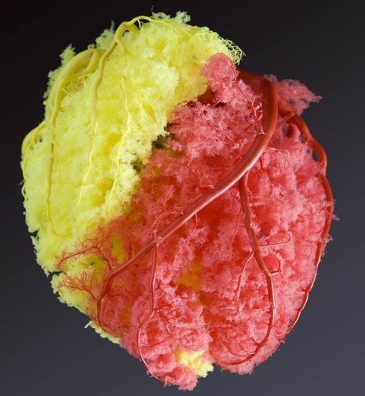 cast of coronary arteries