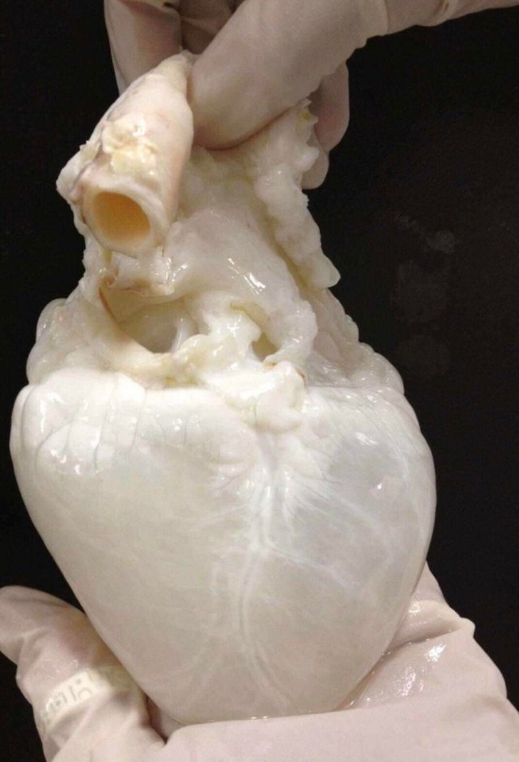 human heart drained of blood