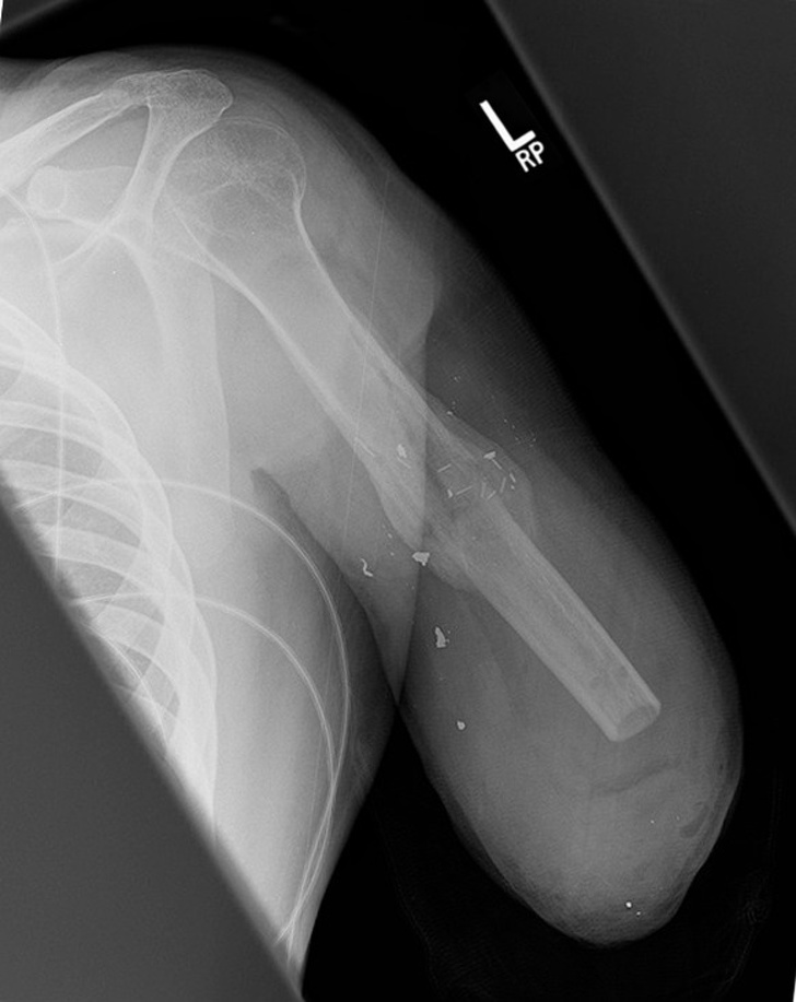arm amputation x ray