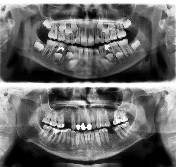 panoramic xray teeth