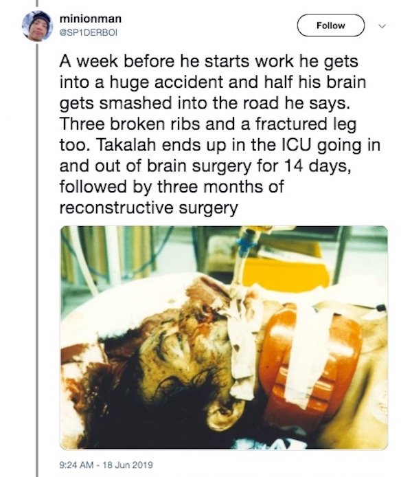 minionman A week before he starts work he gets into a huge accident and half his brain gets smashed into the road he says. Three broken ribs and a fractured leg too. Takalah ends up in the Icu going in and out of brain surgery for 14 days, ed by three…