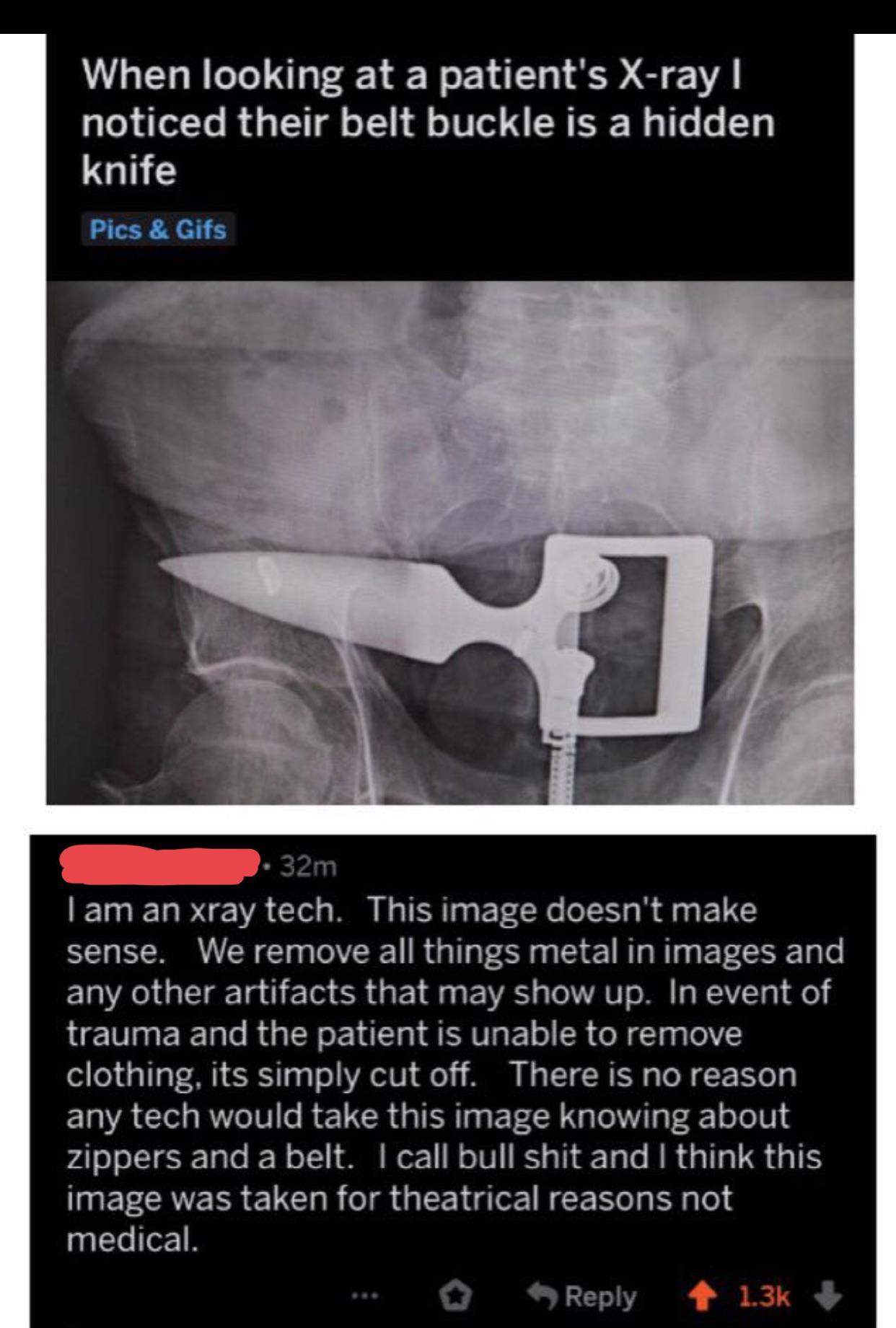 social media liars - When looking at a patient's Xray| noticed their belt buckle is a hidden knife  I am an xray tech. This image doesn't make sense. We remove all things metal in images and any other artifacts that may show up.