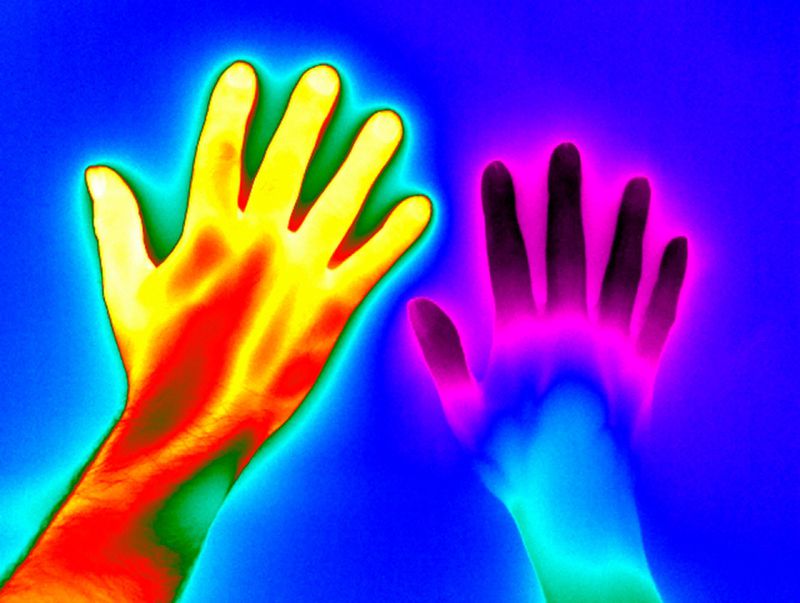 A healthy hand (left) and the hand of a person with Raynaud’s disease (right).