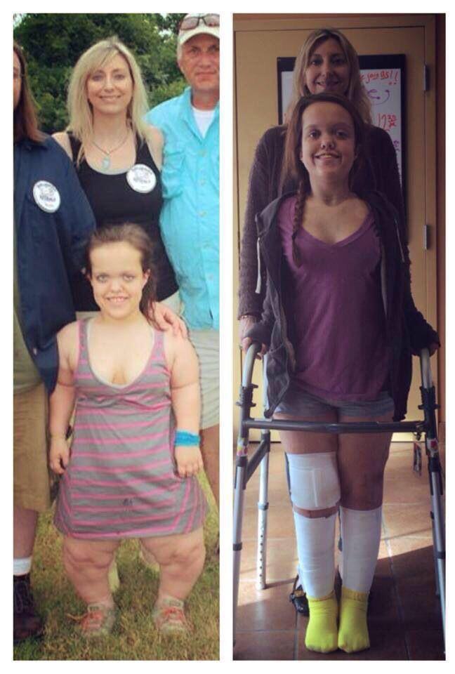 Before and after limb lengthening.