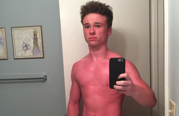 sunburnt white people - barechestedness