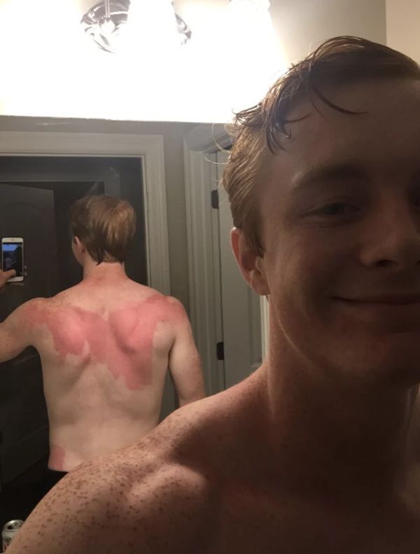 sunburnt white people - barechestedness
