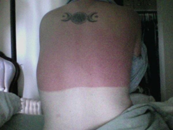 sunburnt white people - shoulder