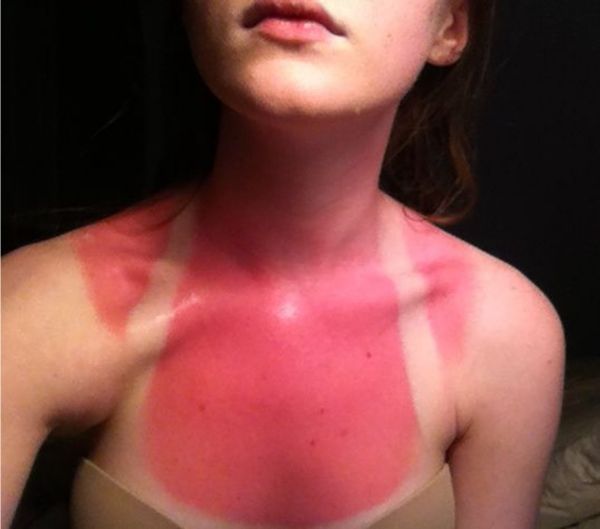 sunburnt white people - worst sunburn