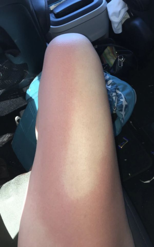 sunburnt white people - thigh