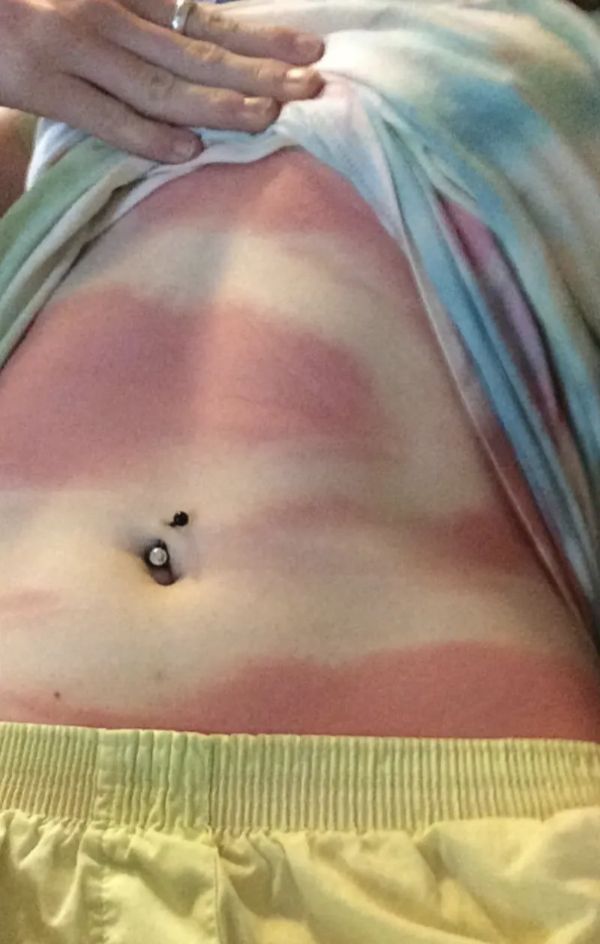 sunburnt white people - close up