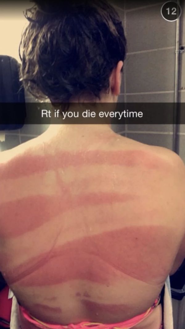 sunburnt white people - barechestedness - 12 Rt if you die everytime
