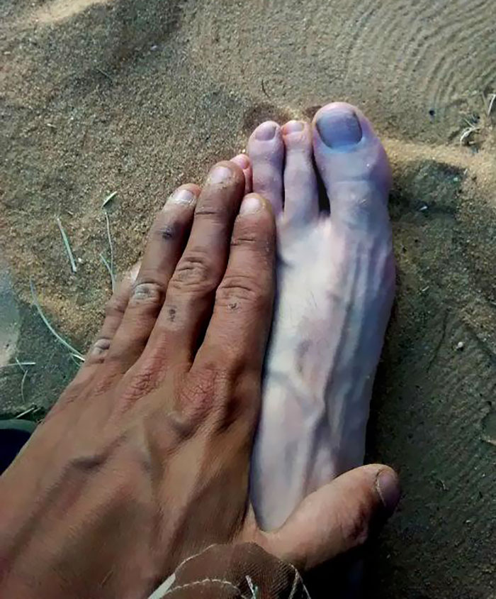 The Tan Of his Hand Compared To his Foot