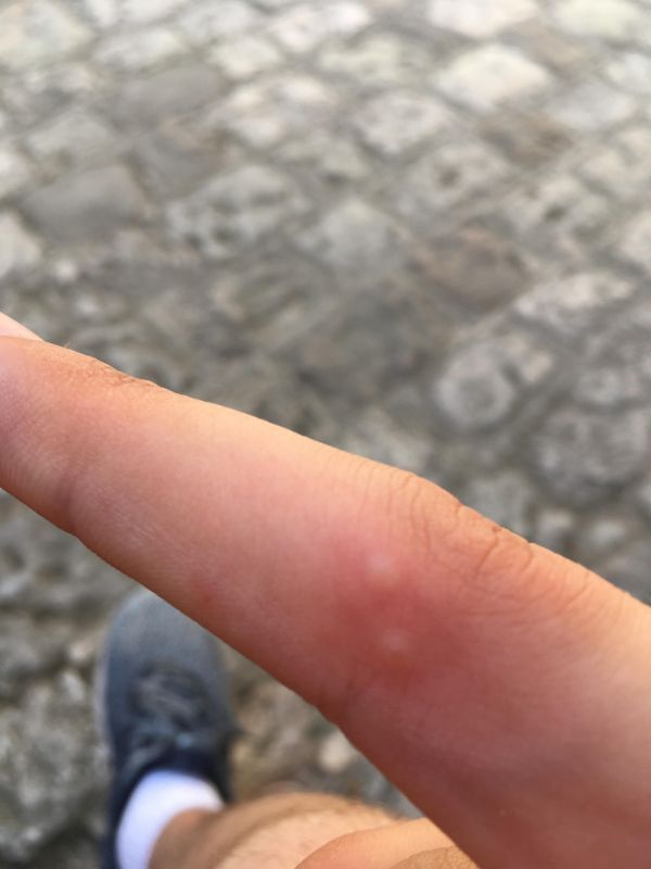 infuriating mosquito bites on hands