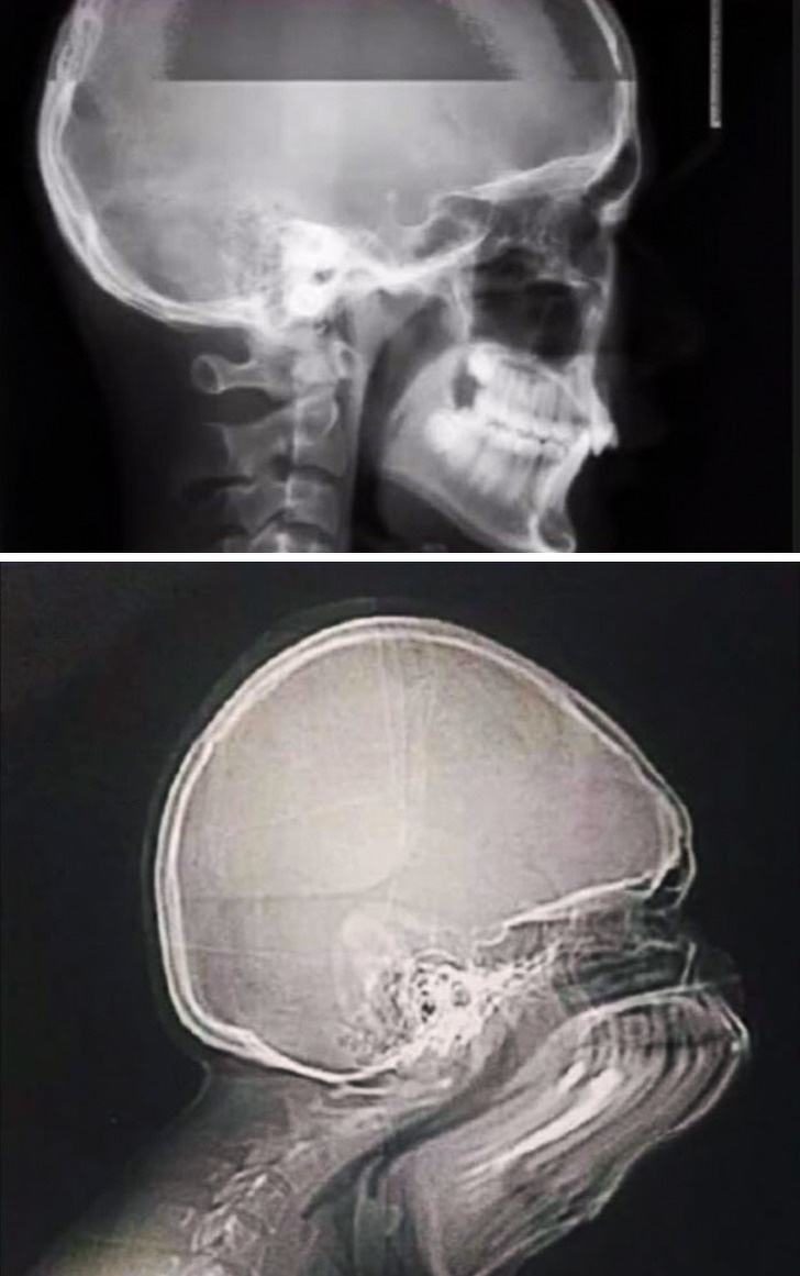 What happens if you sneeze while taking X-ray?