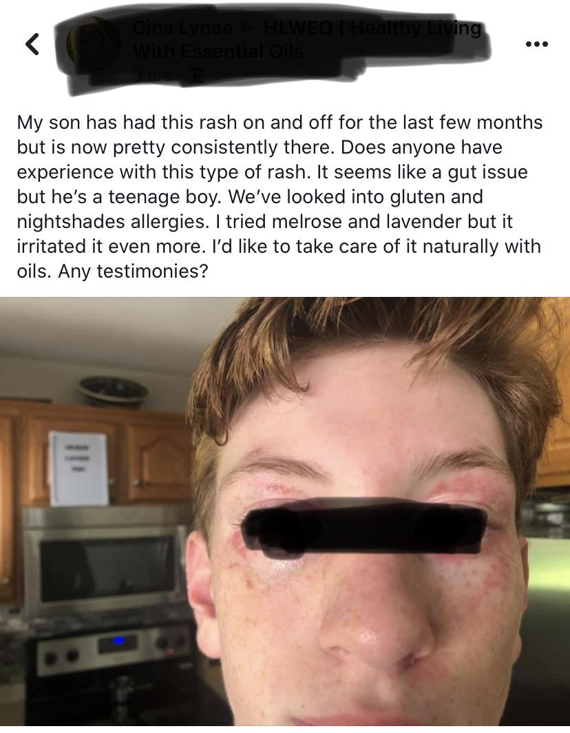 eye - Gina Lynae Hlwed THealthy Living My son has had this rash on and off for the last few months but is now pretty consistently there. Does anyone have experience with this type of rash. It seems a gut issue but he's a teenage boy. We've looked into glu