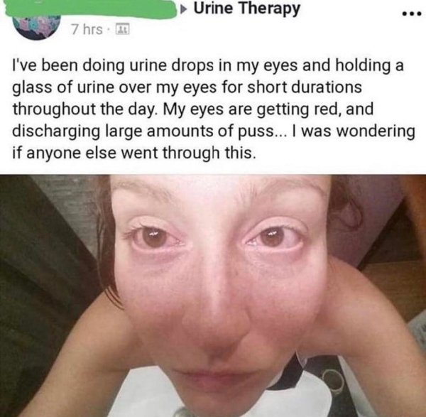 lip - Urine Therapy 7 hrs. I've been doing urine drops in my eyes and holding a glass of urine over my eyes for short durations throughout the day. My eyes are getting red, and discharging large amounts of puss... I was wondering if anyone else went throu