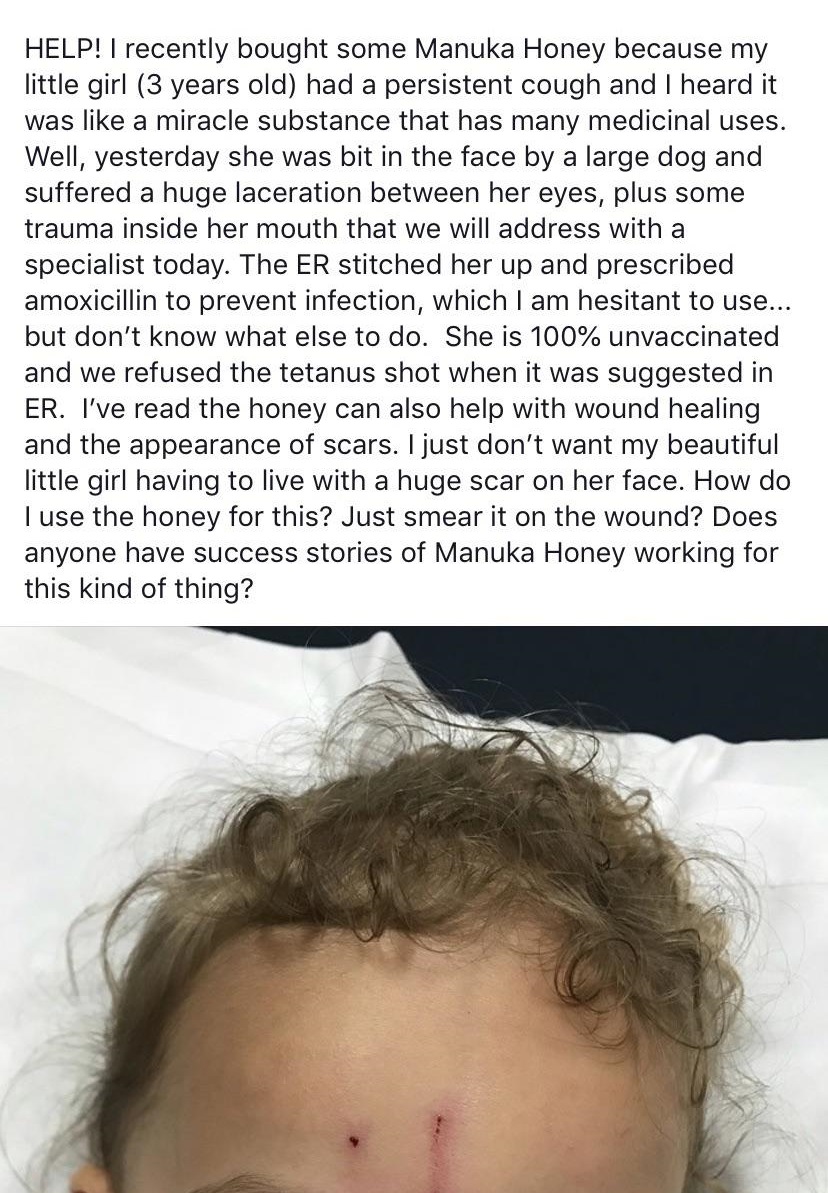Help! I recently bought some Manuka Honey because my little girl 3 years old had a persistent cough and I heard it was a miracle substance that has many medicinal uses. Well, yesterday she was bit in the face by a large dog and suffered a huge laceration…