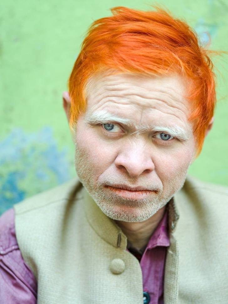 ginger albino