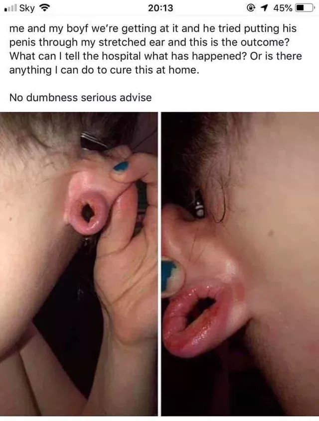 Facepalm - al Sky 4 45%D me and my boyf we're getting at it and he tried putting his penis through my stretched ear and this is the outcome? What can I tell the hospital what has happened? Or is there anything I can do to cure this at home. No dumbness se