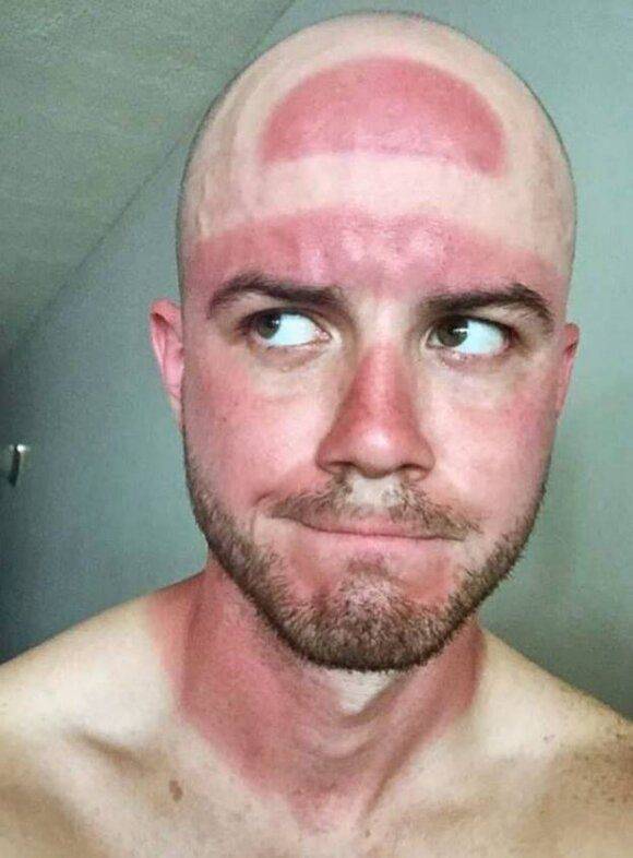 funny sunburns