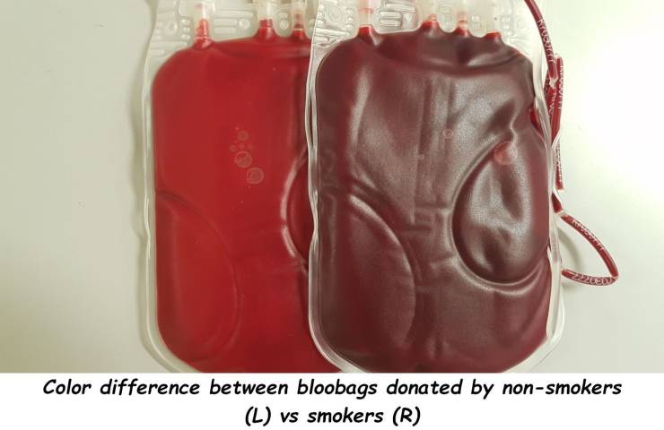 handbag - Color difference between bloobags donated by nonsmokers L vs smokers R