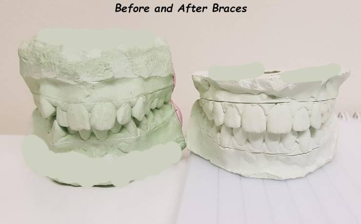 jaw - Before and After Braces