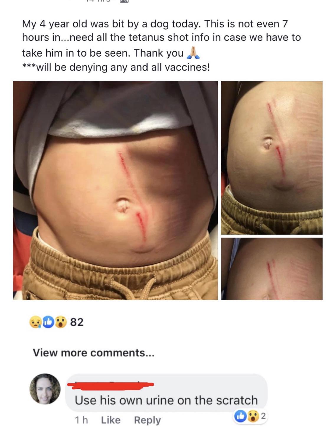 abdomen - My 4 year old was bit by a dog today. This is not even 7 hours in...need all the tetanus shot info in case we have to take him in to be seen. Thank you will be denying any and all vaccines! 082 View more ... Use his own urine on the scratch 1h 2