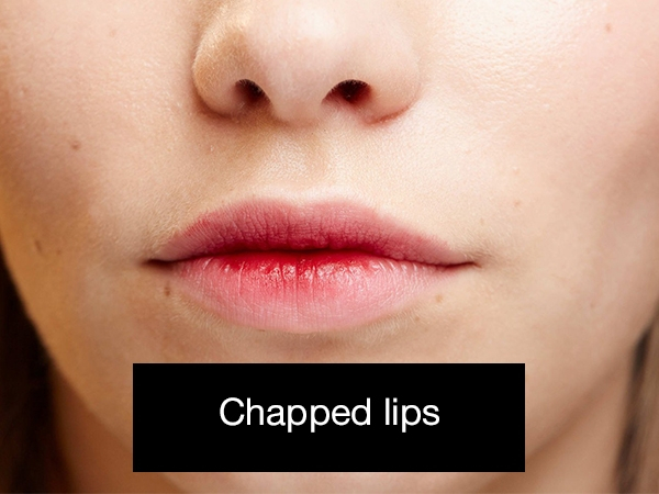 lip - Chapped lips