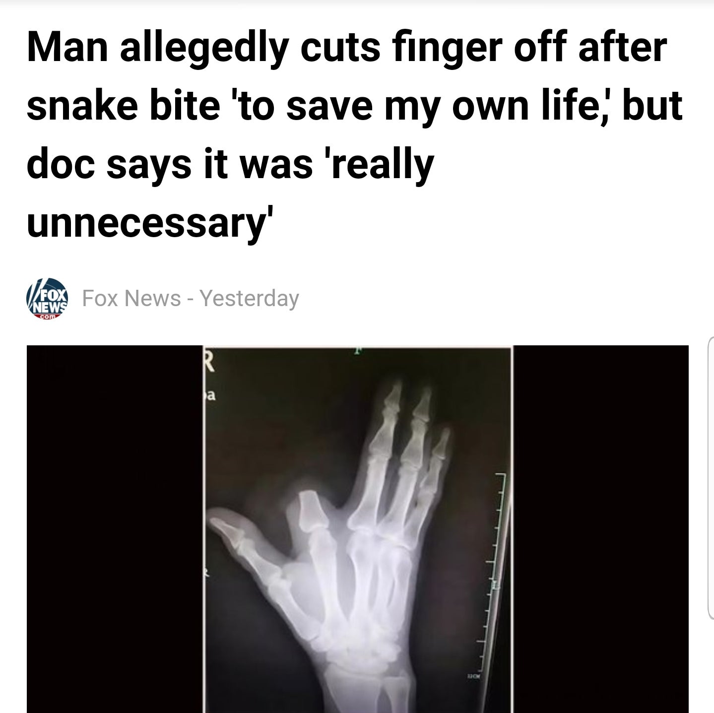 hand - Man allegedly cuts finger off after snake bite 'to save my own life, but doc says it was 'really unnecessary' Fox News Eos Fox News Yesterday com No