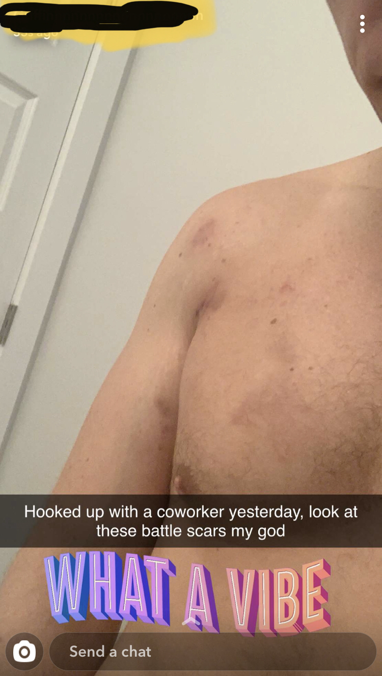 barechestedness - Hooked up with a coworker yesterday, look at these battle scars my god What A Vibe O Send a chat