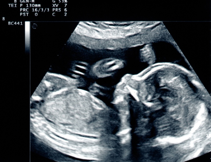 baby ultrasound - X 7 B GenM G53% Tei P 130mm Prc 1633 Prs 6 Pst 0 BC441