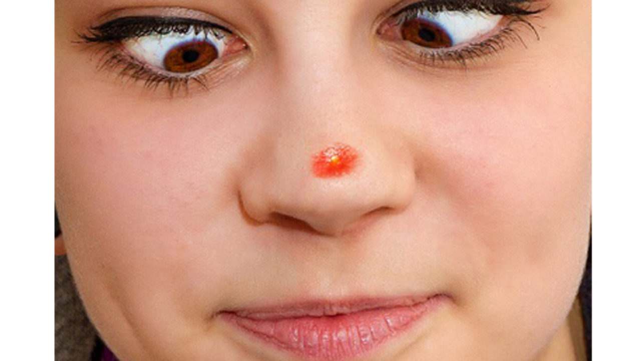 pimple on nose