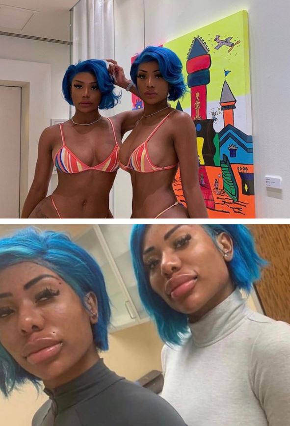 clermont twins surgery
