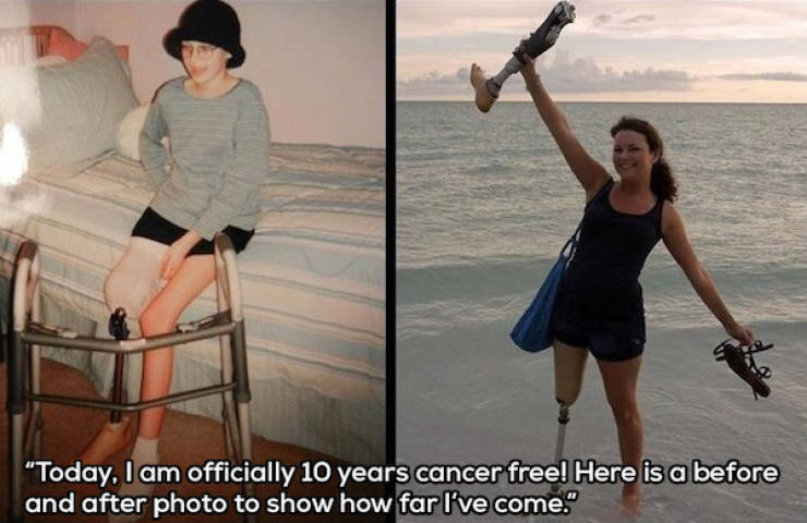 Photograph - "Today. I am officially 10 years cancer free! Here is a before and after photo to show how far I've come."