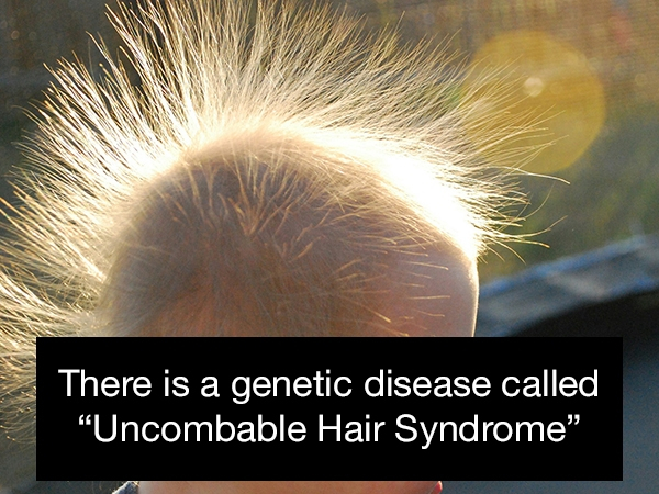 uncombable hair syndrome - There is a genetic disease called "Uncombable Hair Syndrome"