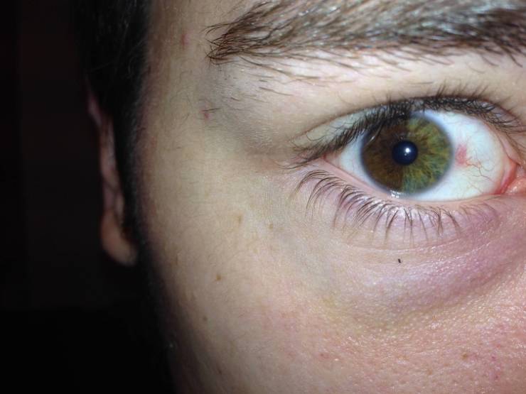 one green eye and one brown eye