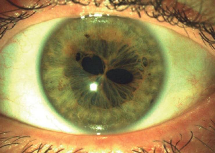polycoria eye