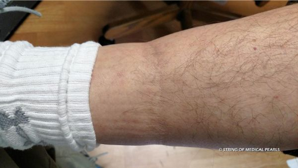sock ring on calf - Ostring Of Medical Pearls