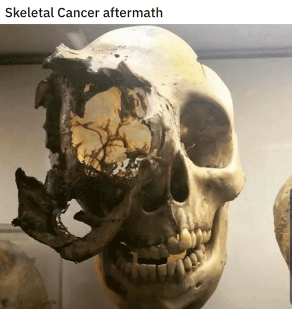 chordoma skull - Skeletal Cancer aftermath