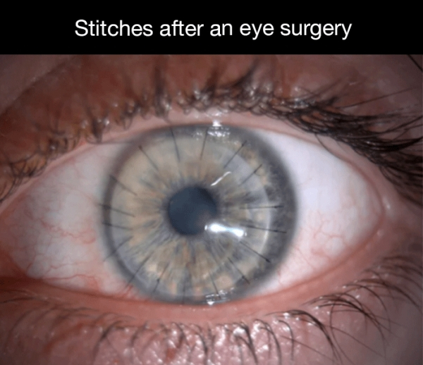 can you get stitches on your eyeball - Stitches after an eye surgery