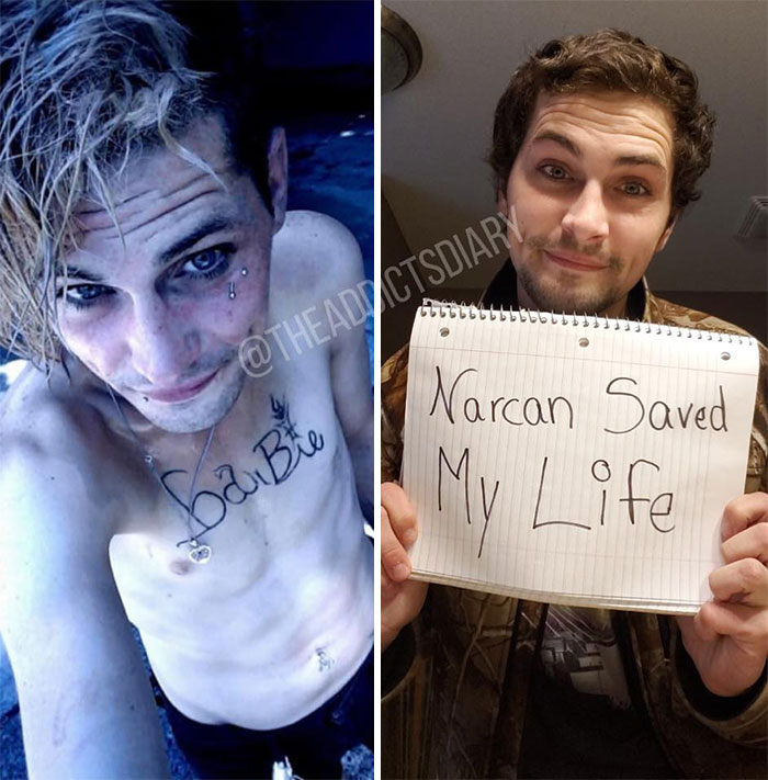 before and after meth recovery - Ctsdiary I Narcan Saved My Life baibre