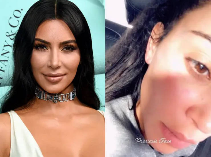 kim kardashian psoriasis face - Jeany & Co. Psoriasis Face