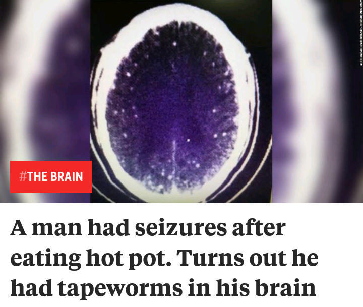 stem - W37ACTS Brain A man had seizures after eating hot pot. Turns out he had tapeworms in his brain