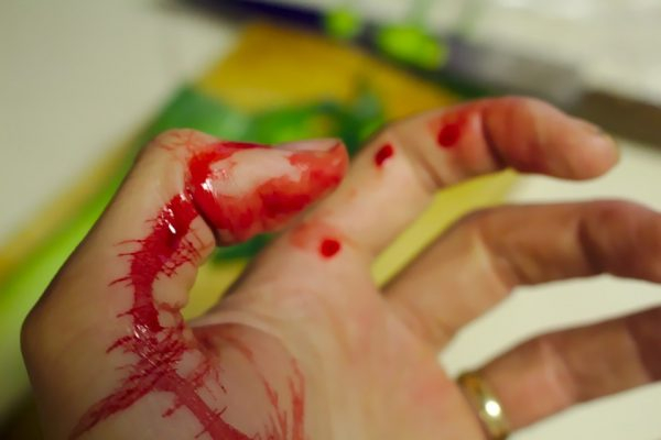hand bleeding