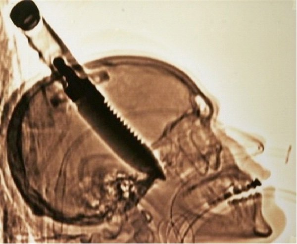 knife in head x ray