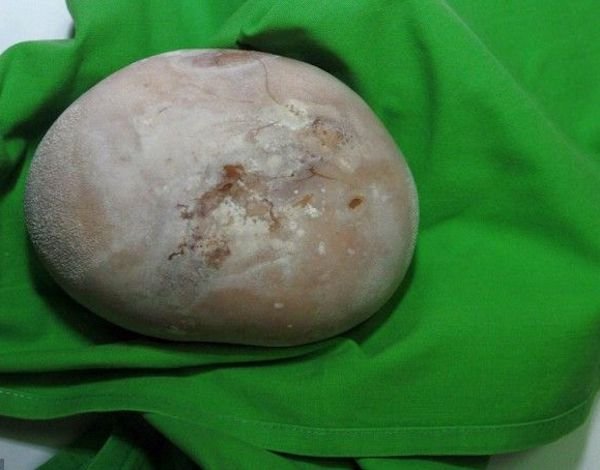 The largest kidney stone.
In 2009, Sandor Sarkadi of Hungary had a 2.5lb kidney stone removed.