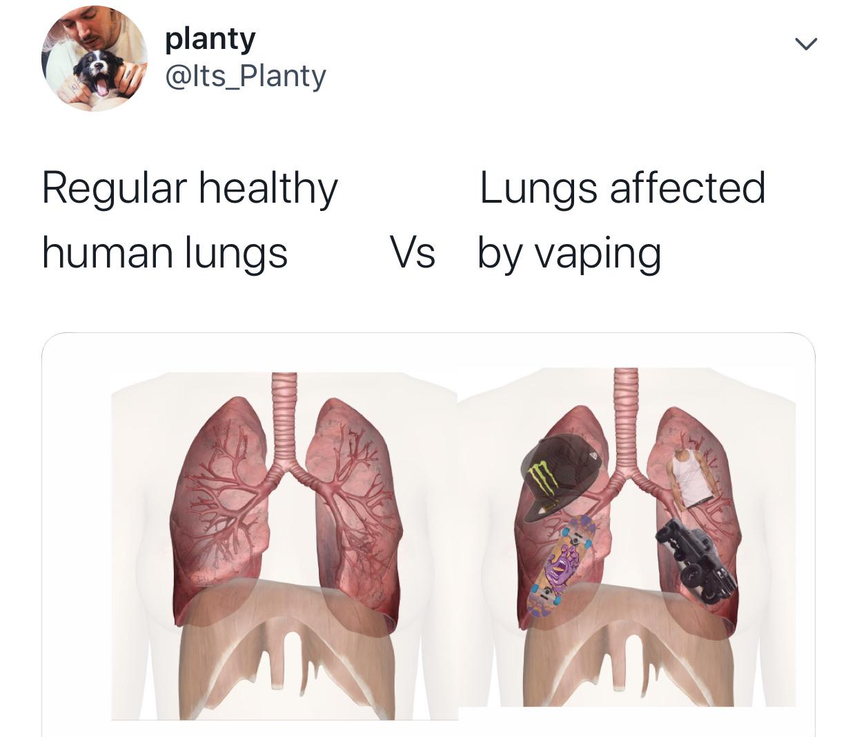 shoulder - & planty planty Regular healthy human lungs Lungs affected Vs by vaping