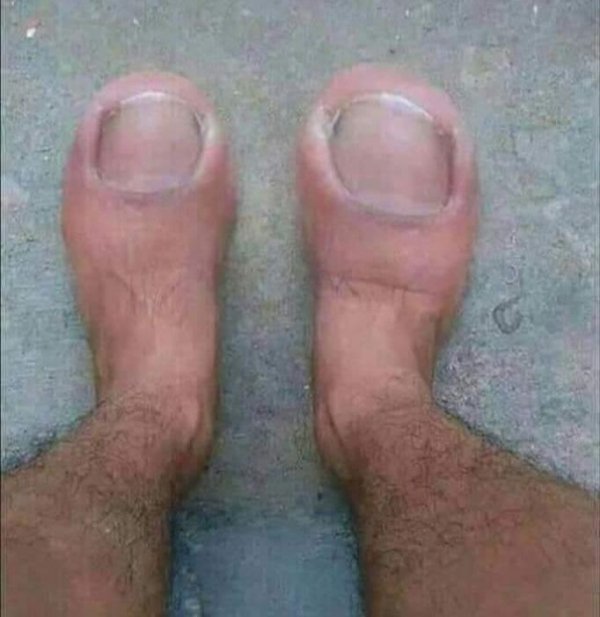 big toe as foot