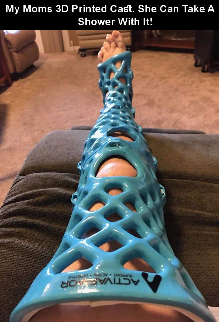 3d printing examples - My Moms 3D Printed Cast. She Can Take A Shower With It!